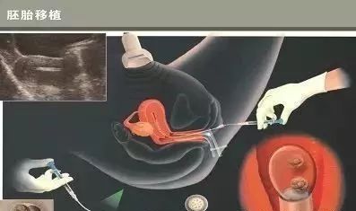 六安捐卵志愿者补充